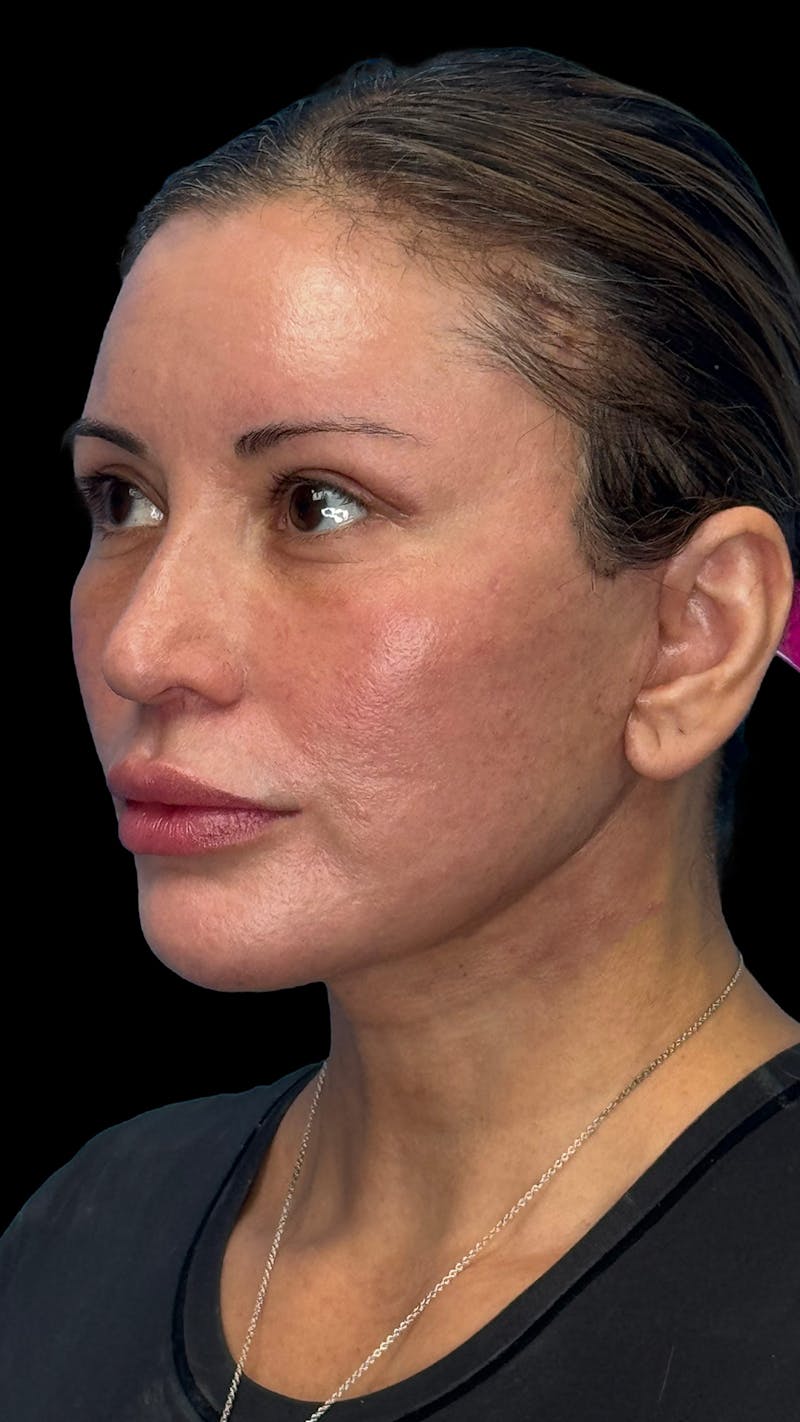 Deep Plane Facelift & Neck Lift LP Before & After Gallery - Patient 390320 - Image 4