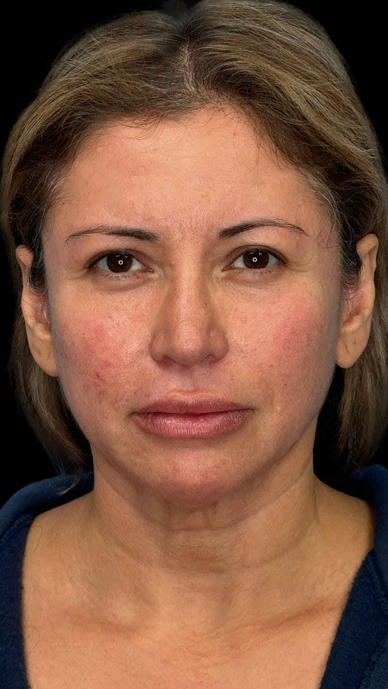 Deep Plane Facelift & Neck Lift LP Before & After Gallery - Patient 390320 - Image 1