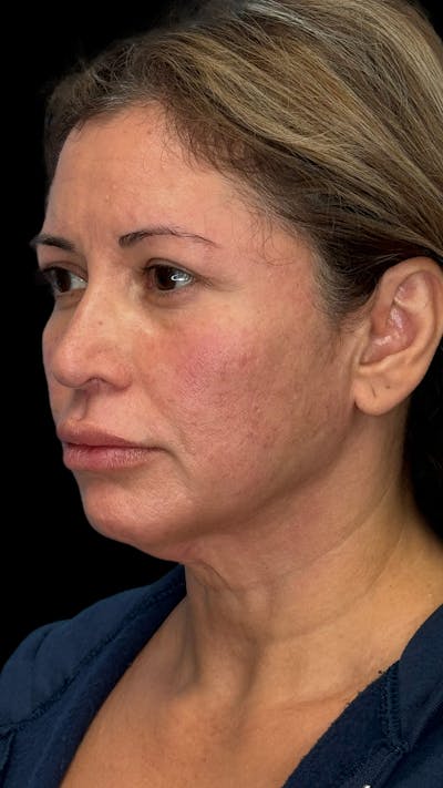 Deep Plane Facelift & Neck Lift LP Before & After Gallery - Patient 223947 - Image 1