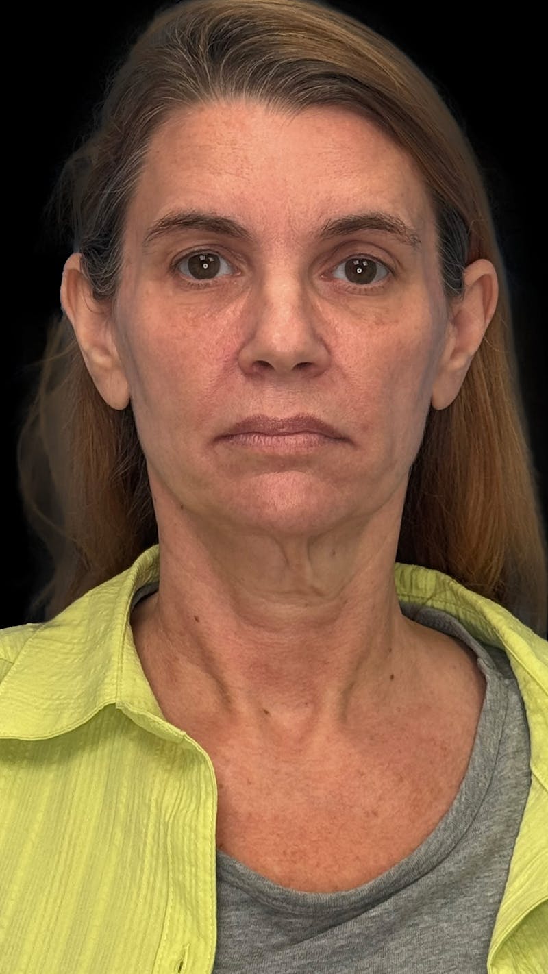 Deep Plane Facelift & Neck Lift LP Before & After Gallery - Patient 199552 - Image 1