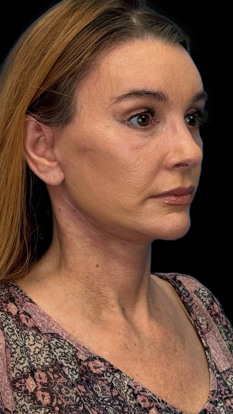 Deep Plane Facelift & Neck Lift LP Before & After Gallery - Patient 199552 - Image 4