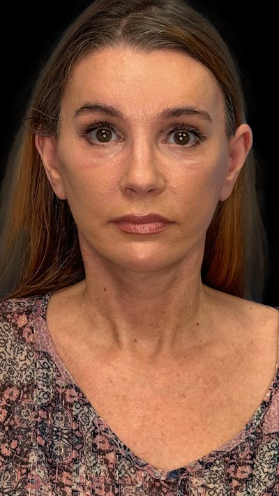 Deep Plane Facelift & Neck Lift LP Before & After Gallery - Patient 199552 - Image 2