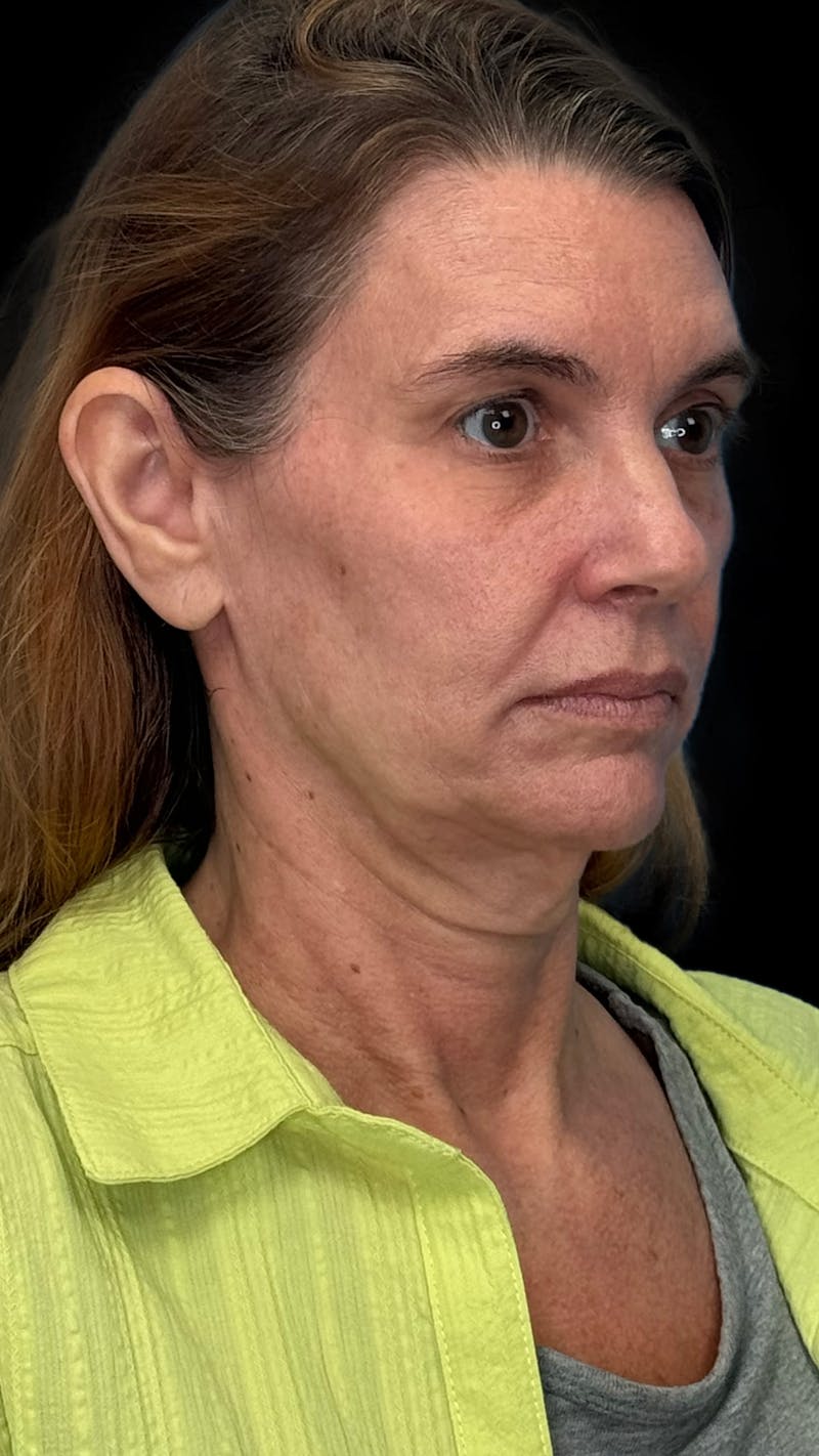 Deep Plane Facelift & Neck Lift LP Before & After Gallery - Patient 199552 - Image 3