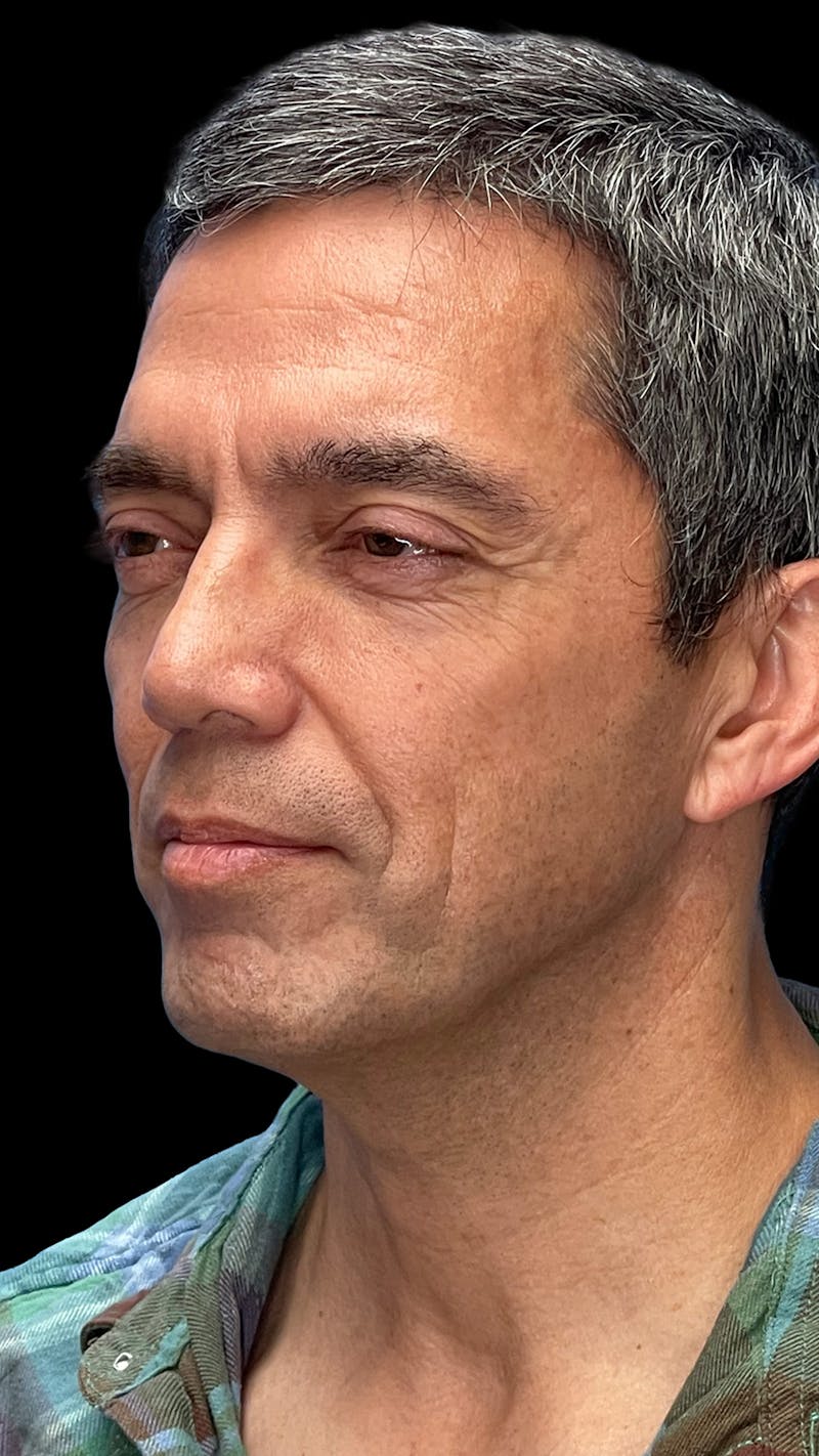 Deep Plane Facelift & Neck Lift LP Before & After Gallery - Patient 226142 - Image 3