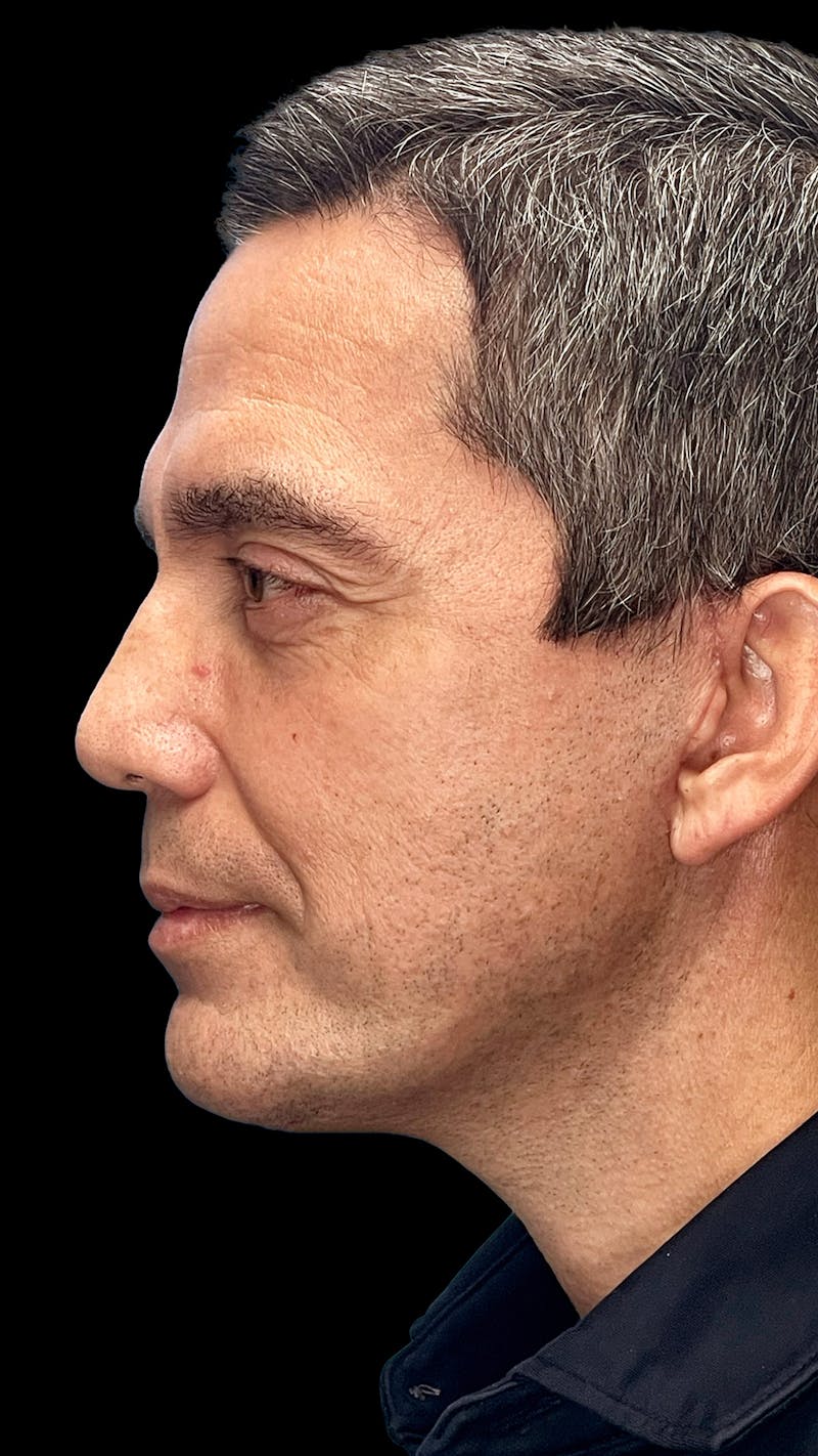 Deep Plane Facelift & Neck Lift LP Before & After Gallery - Patient 226142 - Image 2