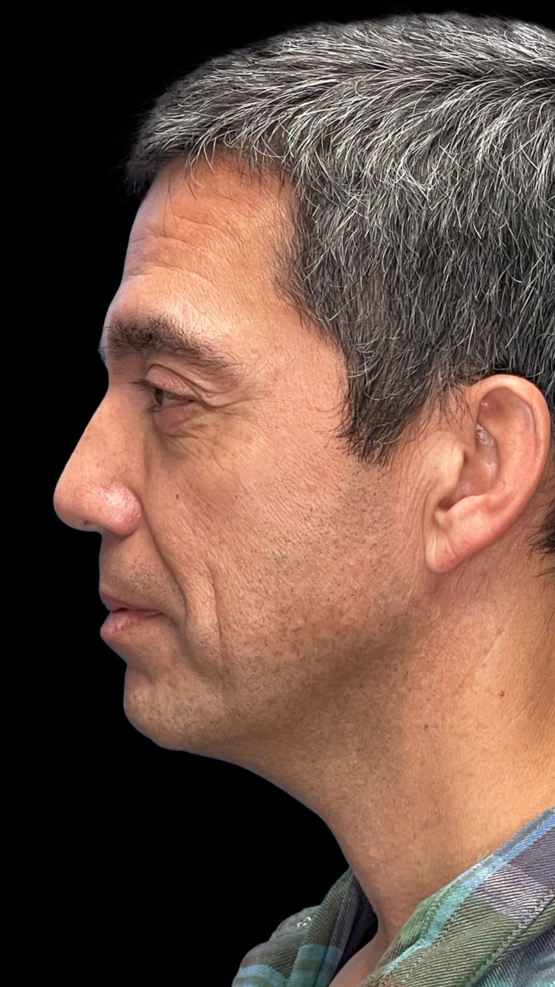 Deep Plane Facelift & Neck Lift LP Before & After Gallery - Patient 226142 - Image 1