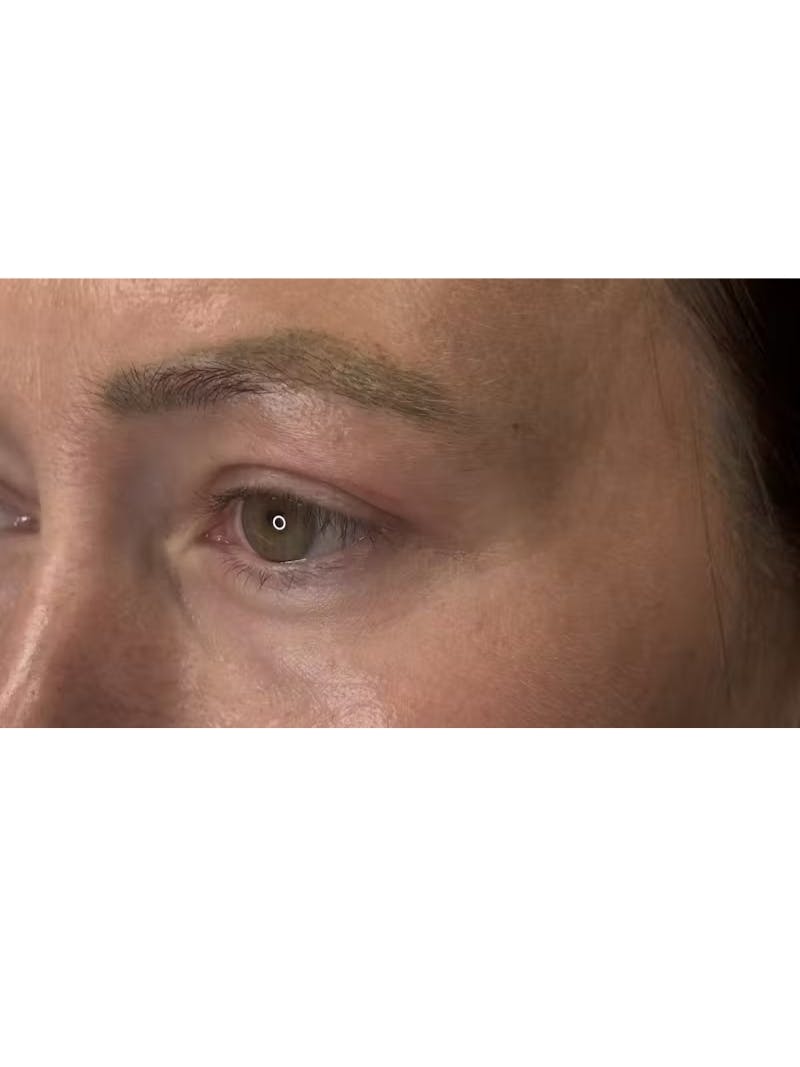 Upper Eye Rejuvenation Before & After Gallery - Patient 267655 - Image 10
