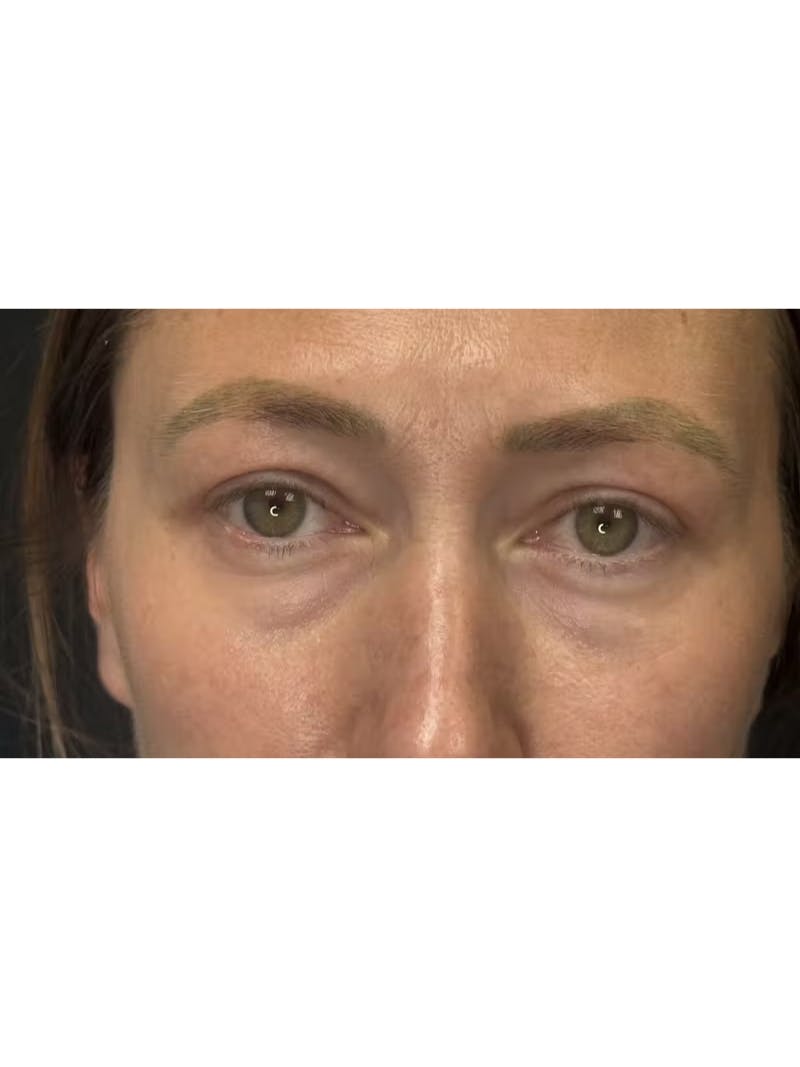 Upper Eye Rejuvenation Before & After Gallery - Patient 267655 - Image 6