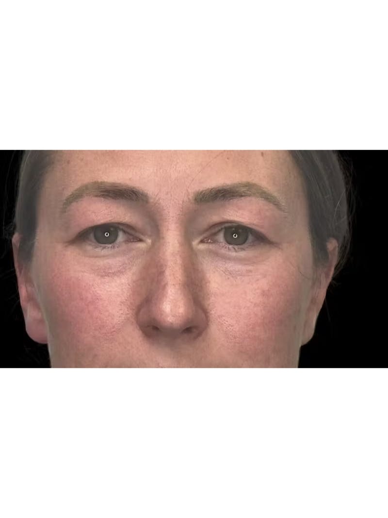 Upper Eye Rejuvenation Before & After Gallery - Patient 267655 - Image 5