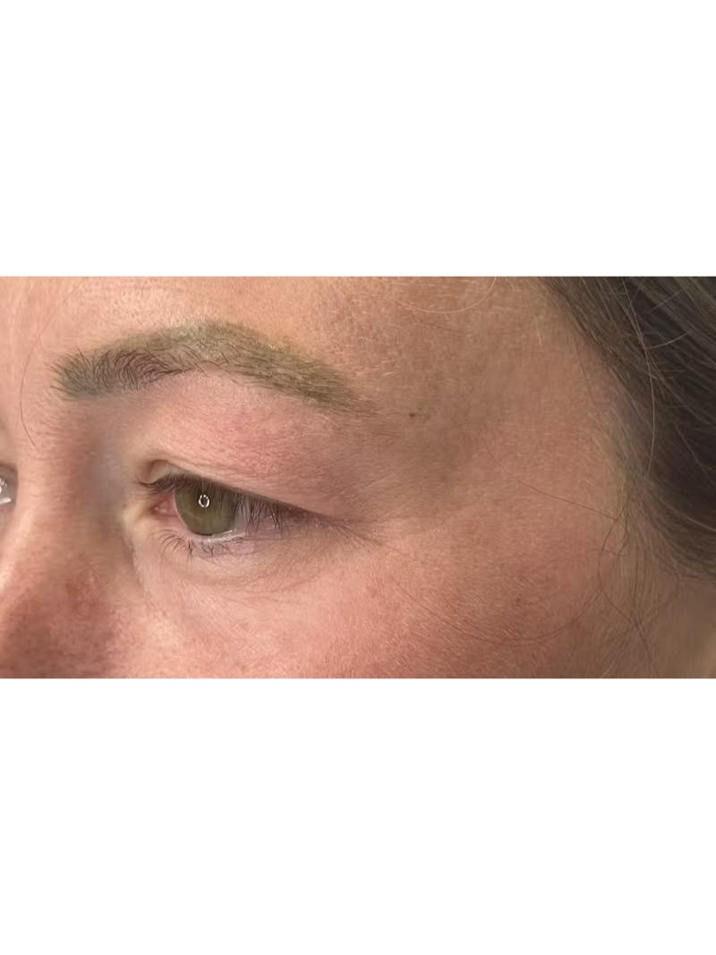 Upper Eye Rejuvenation Before & After Gallery - Patient 267655 - Image 9