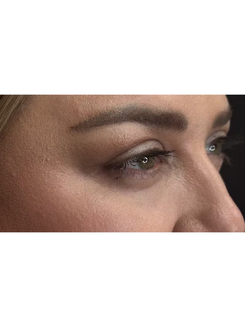Upper Eye Rejuvenation Before & After Gallery - Patient 179840 - Image 6