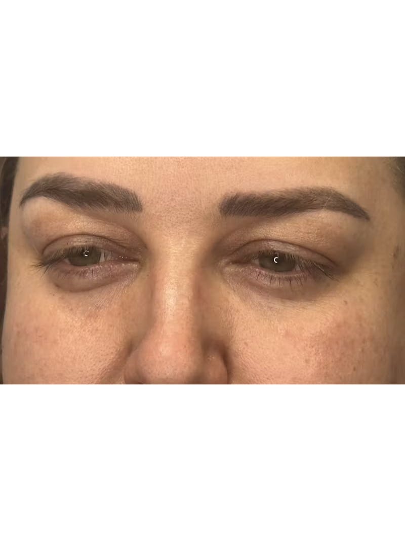 Upper Eye Rejuvenation Before & After Gallery - Patient 179840 - Image 3