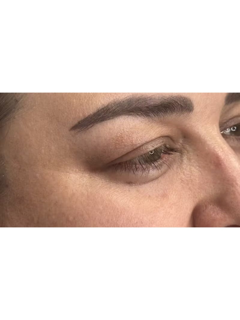 Upper Eye Rejuvenation Before & After Gallery - Patient 179840 - Image 5
