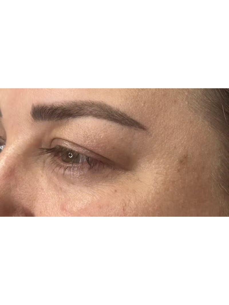 Upper Eye Rejuvenation Before & After Gallery - Patient 179840 - Image 7