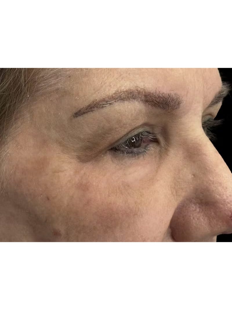 Upper Eye Rejuvenation Before & After Gallery - Patient 194034 - Image 6