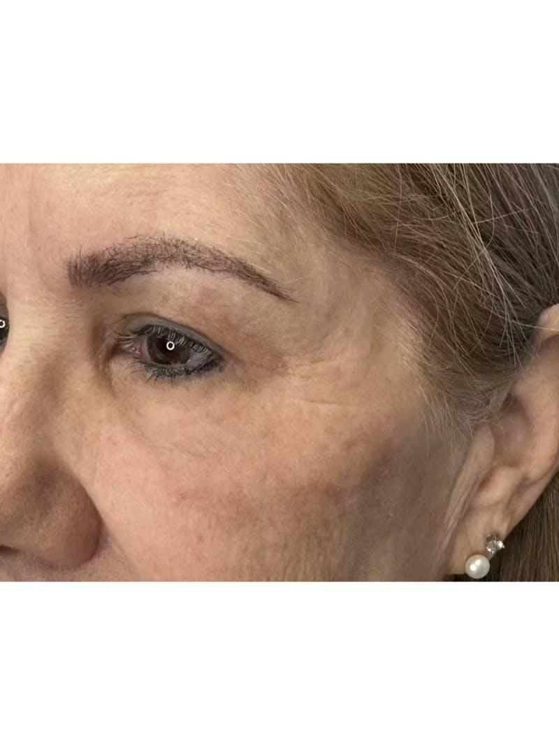 Upper Eye Rejuvenation Before & After Gallery - Patient 194034 - Image 8