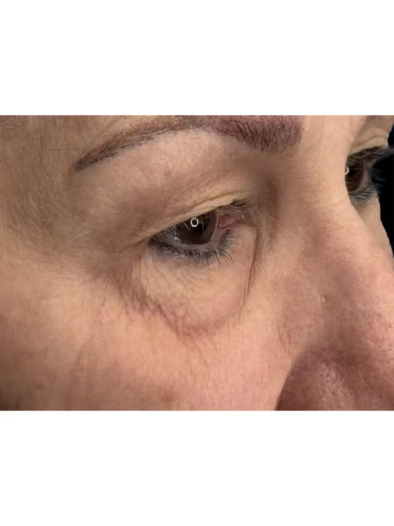 Upper Eye Rejuvenation Before & After Gallery - Patient 194034 - Image 5