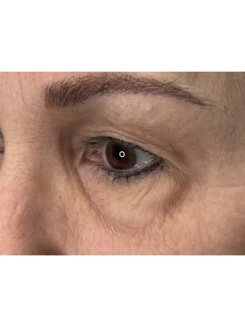 Upper Eye Rejuvenation Before & After Gallery - Patient 194034 - Image 7