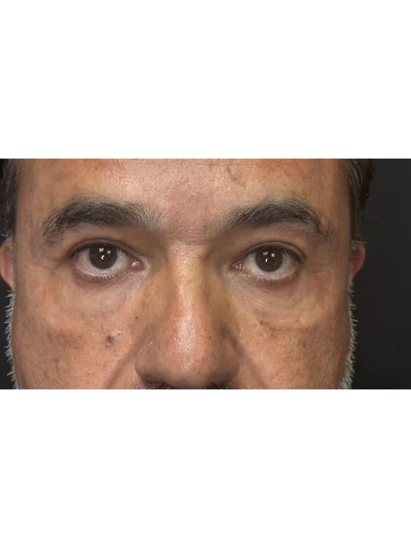 Lower Eye Rejuvenation Before & After Gallery - Patient 293519 - Image 8