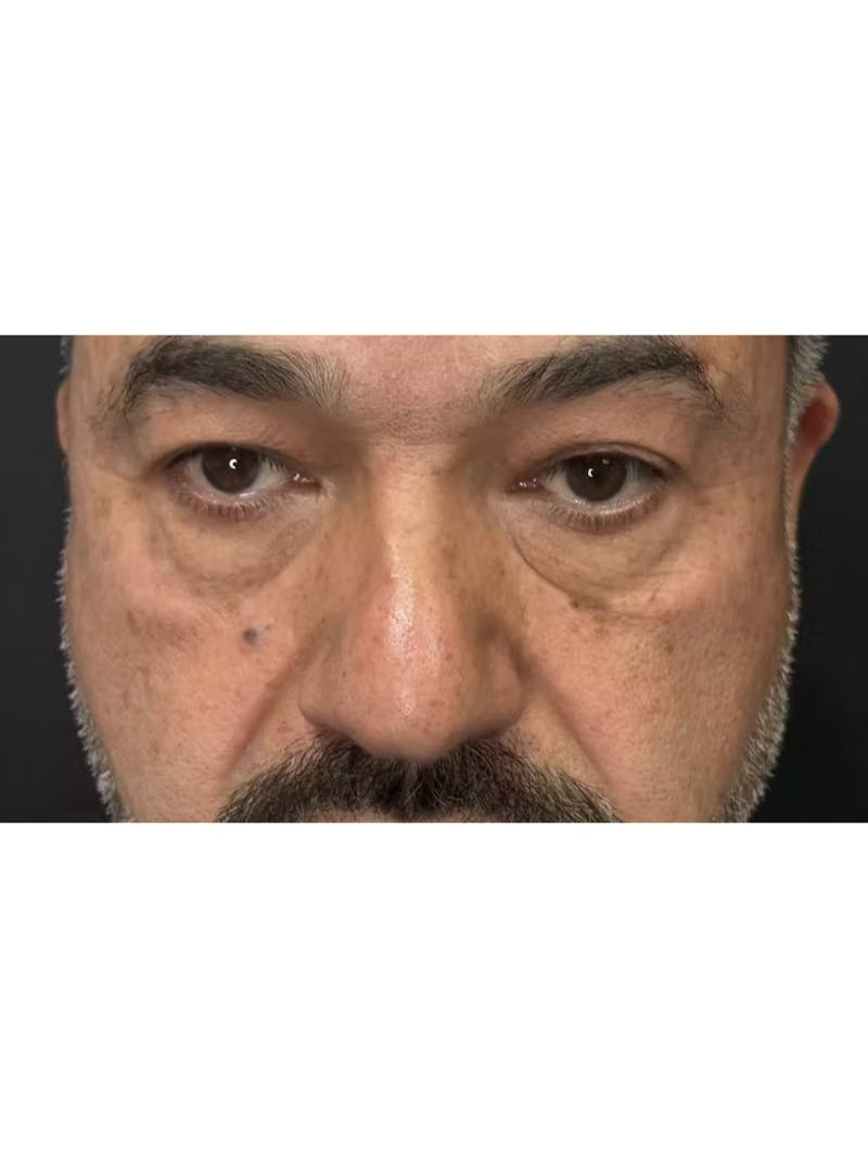 Lower Eye Rejuvenation Before & After Gallery - Patient 293519 - Image 7