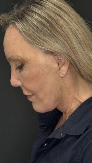 Deep Plane Facelift 60s Before & After Gallery - Patient 310718 - Image 10