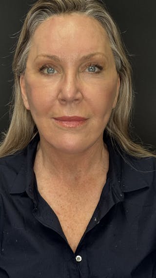 Deep Plane Facelift 60s Before & After Gallery - Patient 310718 - Image 2