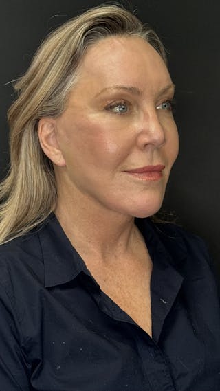 Deep Plane Facelift 60s Before & After Gallery - Patient 310718 - Image 4