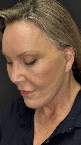 Deep Plane Facelift 60s Before & After Gallery - Patient 310718 - Image 8