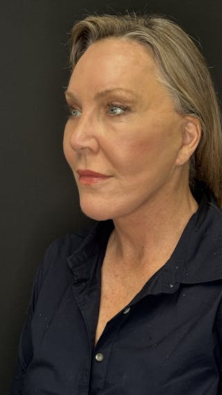 Deep Plane Facelift 60s Before & After Gallery - Patient 310718 - Image 6