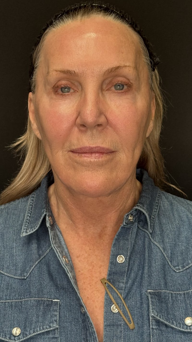 Deep Plane Facelift 60s Before & After Gallery - Patient 310718 - Image 1