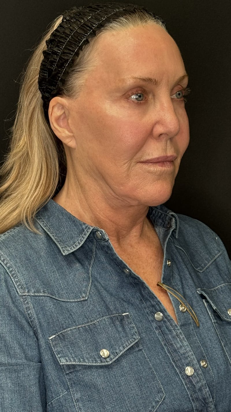 Deep Plane Facelift 60s Before & After Gallery - Patient 310718 - Image 3