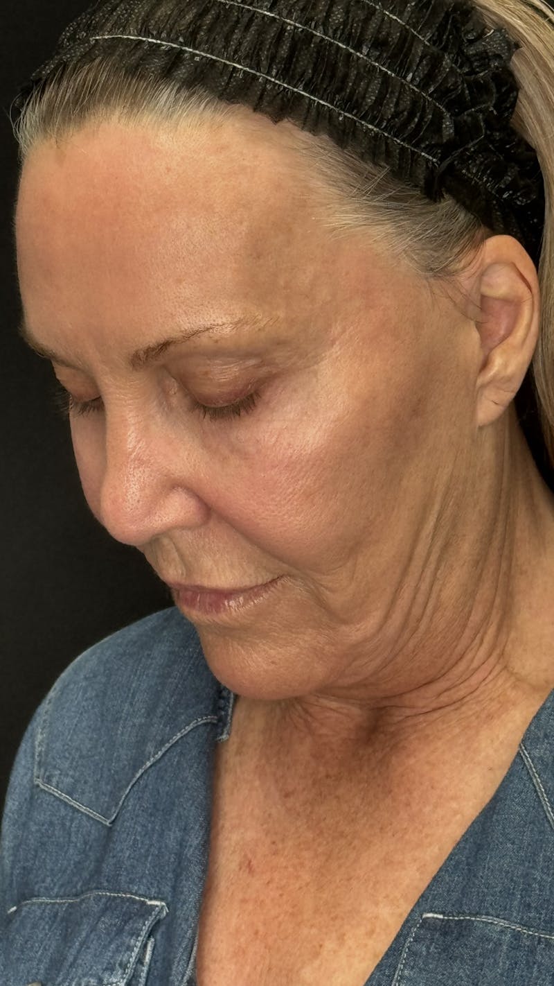 Deep Plane Facelift 60s Before & After Gallery - Patient 310718 - Image 7