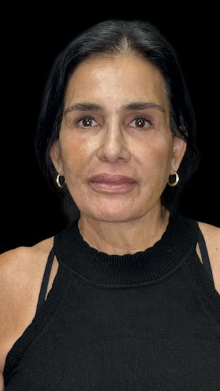 Facial Fat Grafting Before & After Gallery - Patient 367893 - Image 2