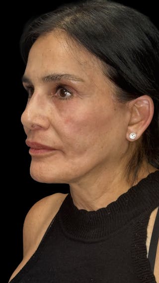 Facial Fat Grafting Before & After Gallery - Patient 367893 - Image 4