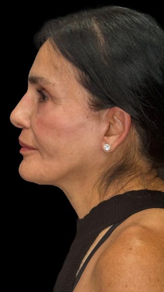 Facial Fat Grafting Before & After Gallery - Patient 367893 - Image 6
