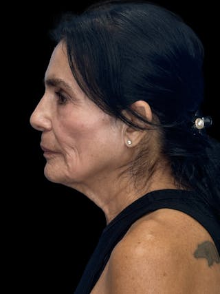 Facial Fat Grafting Before & After Gallery - Patient 367893 - Image 6