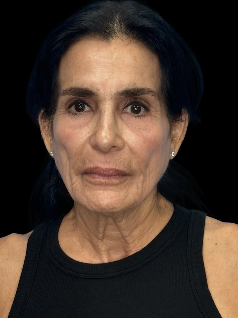 Facial Fat Grafting Before & After Gallery - Patient 367893 - Image 1