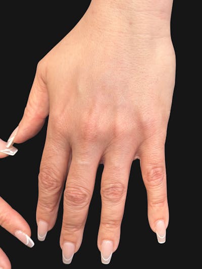Hand Rejuvenation with Fat Grafting Before & After Gallery - Patient 211231 - Image 2