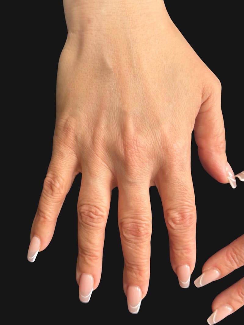 Hand Rejuvenation with Fat Grafting Before & After Gallery - Patient 211231 - Image 4