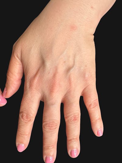 Hand Rejuvenation with Fat Grafting Before & After Gallery - Patient 211231 - Image 1