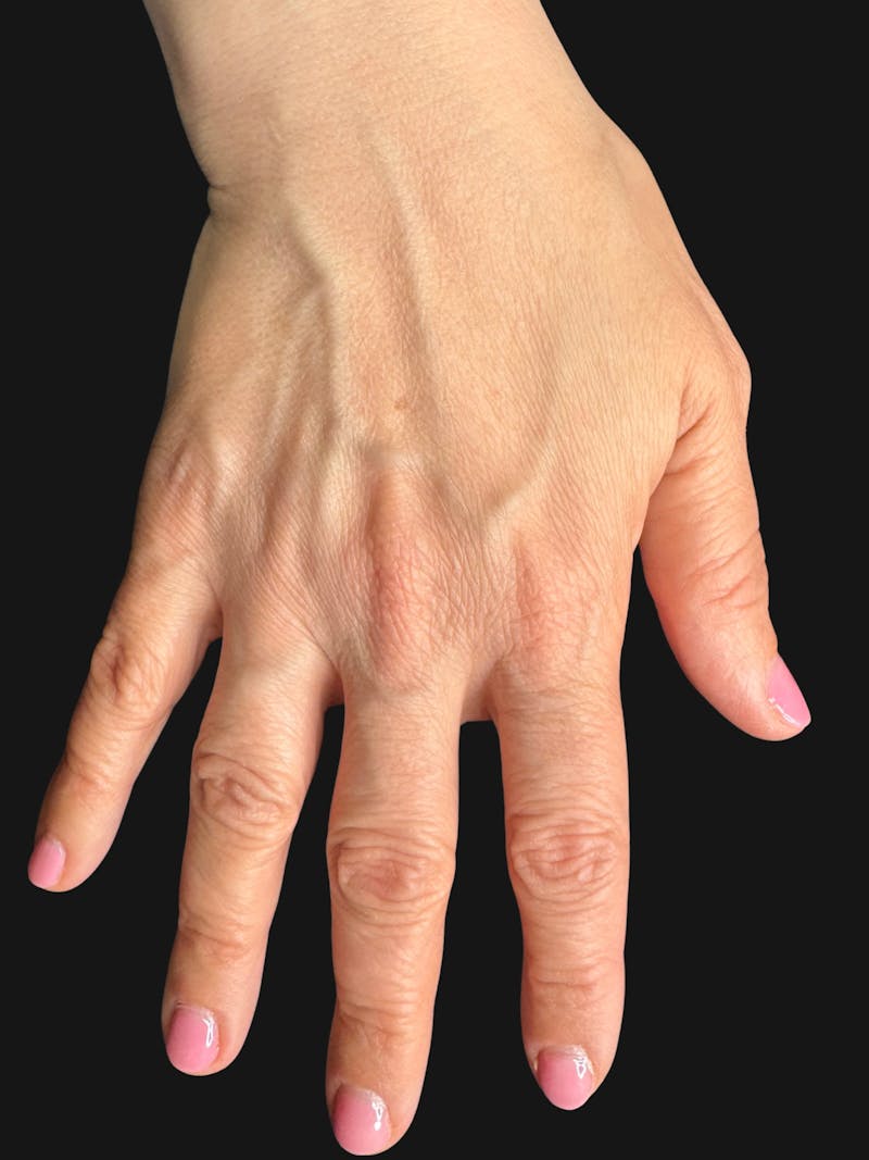 Hand Rejuvenation with Fat Grafting Before & After Gallery - Patient 211231 - Image 3