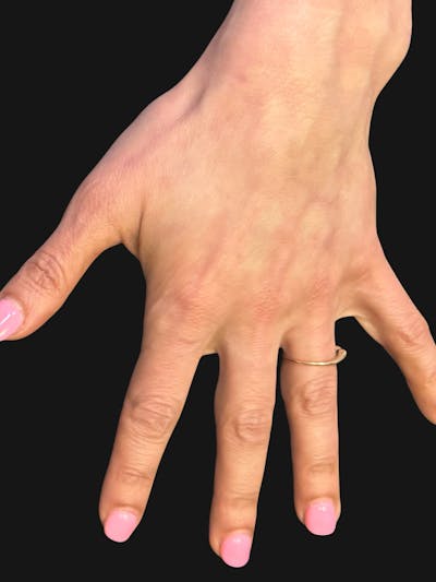 Hand Rejuvenation with Fat Grafting Before & After Gallery - Patient 363686 - Image 2
