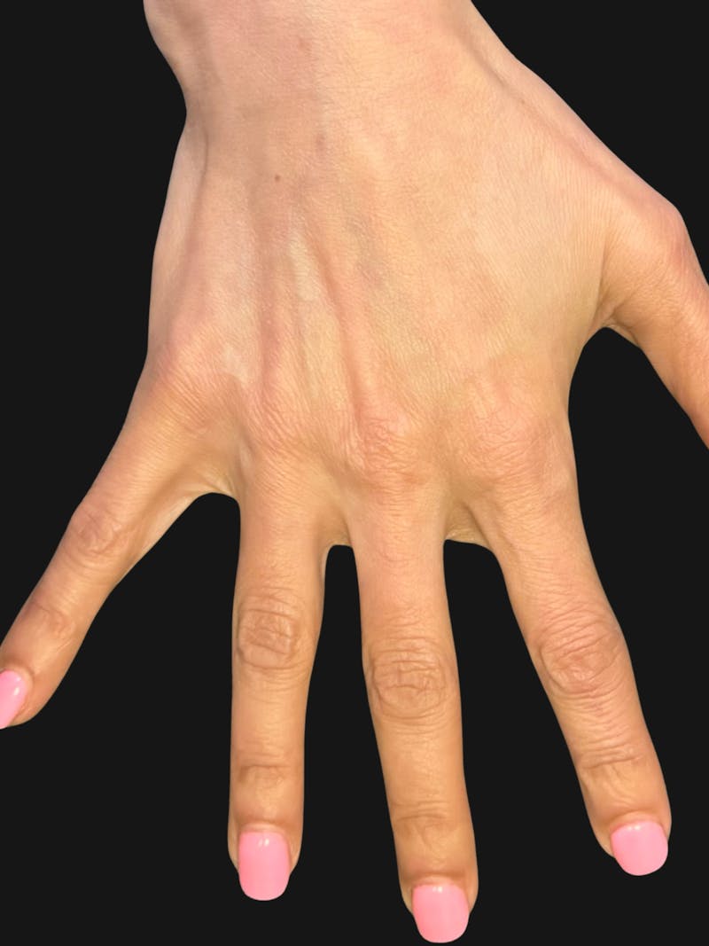 Hand Rejuvenation with Fat Grafting Before & After Gallery - Patient 363686 - Image 4