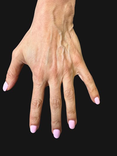 Hand Rejuvenation with Fat Grafting Before & After Gallery - Patient 363686 - Image 1