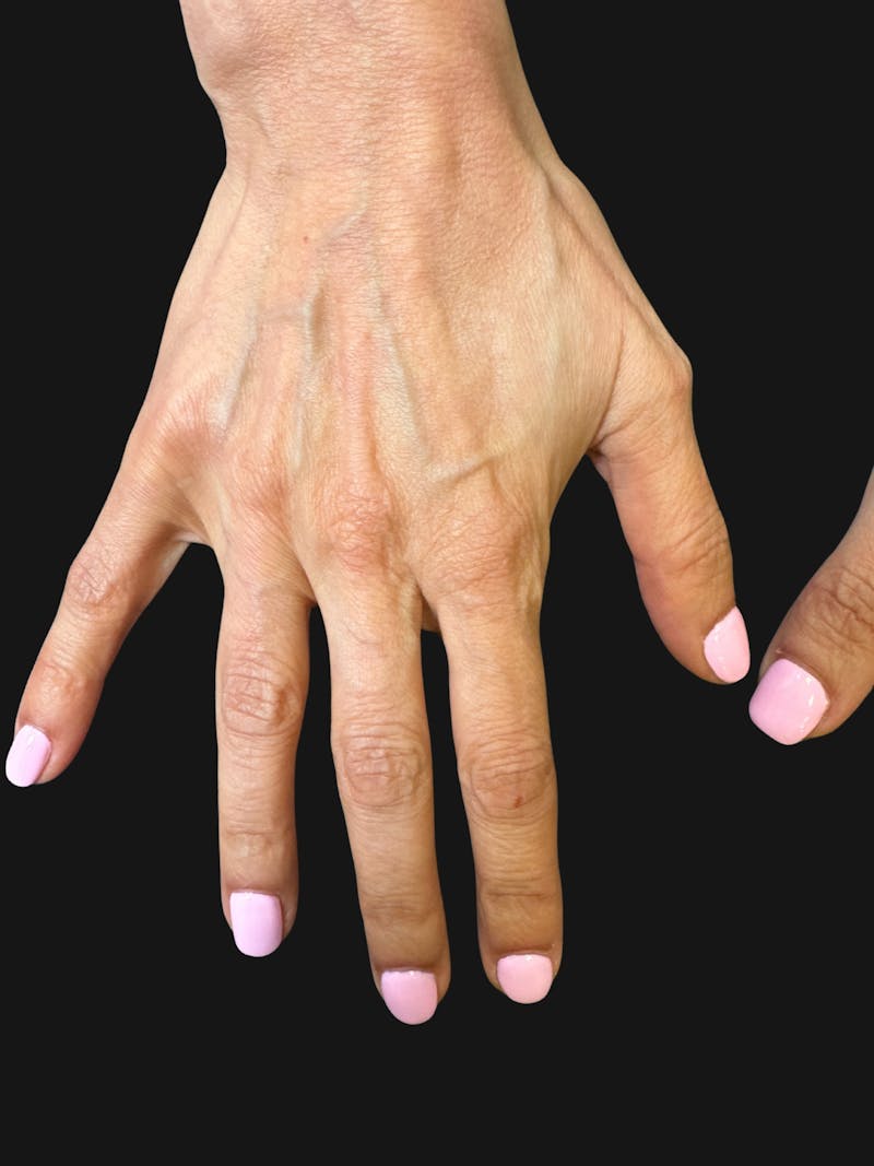 Hand Rejuvenation with Fat Grafting Before & After Gallery - Patient 363686 - Image 3