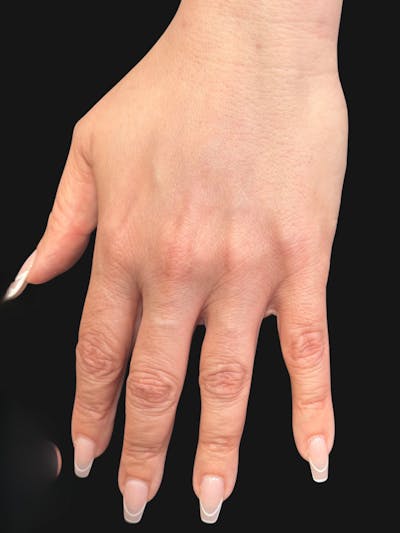 Hand Rejuvenation with Fat Grafting Before & After Gallery - Patient 211231 - Image 2