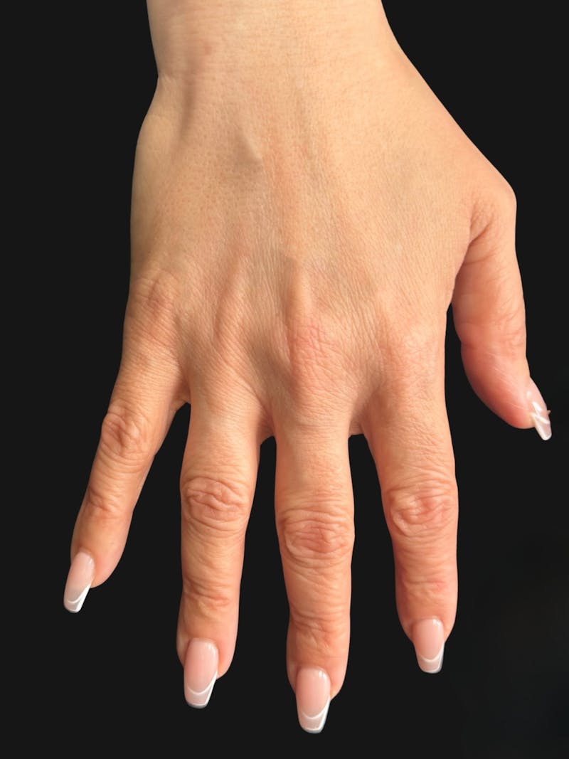 Hand Rejuvenation with Fat Grafting Before & After Gallery - Patient 211231 - Image 4