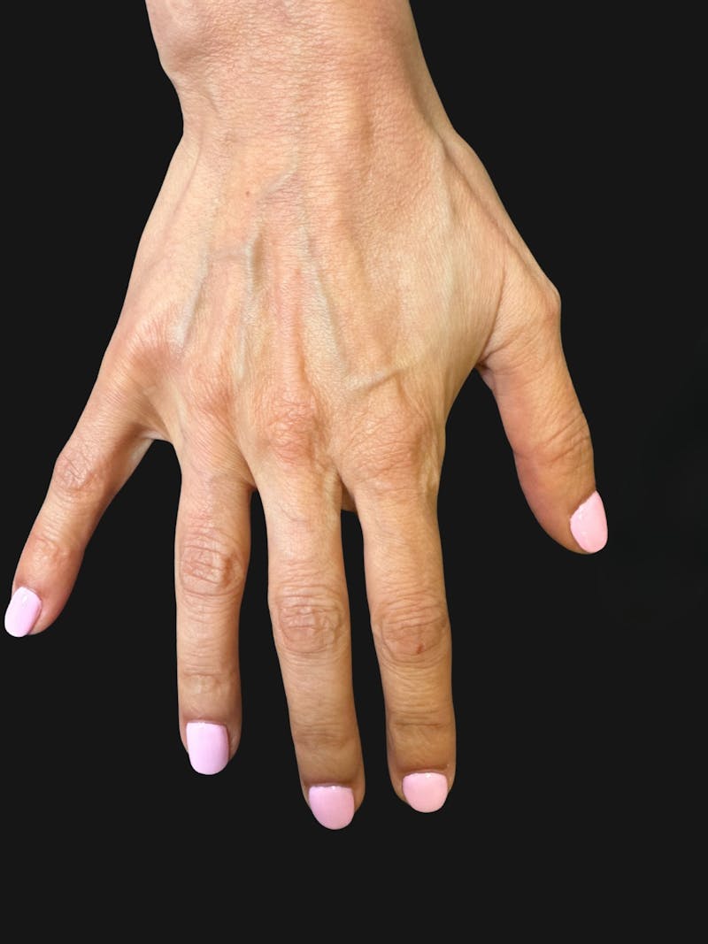 Hand Rejuvenation with Fat Grafting Before & After Gallery - Patient 363686 - Image 3