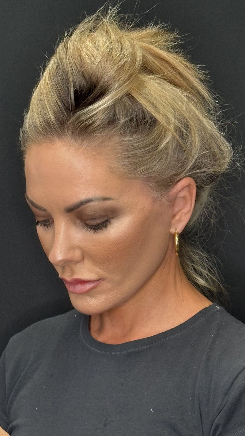 Deep Plane Facelift 40s Before & After Gallery - Patient 419923 - Image 6