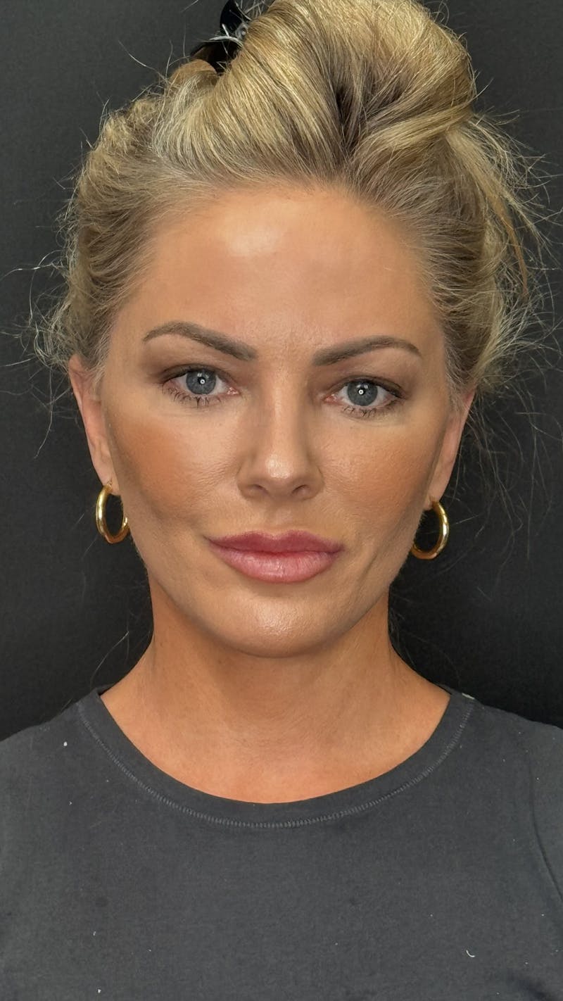 Deep Plane Facelift 40s Before & After Gallery - Patient 419923 - Image 2